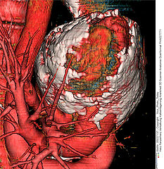 Calcifying pericarditis (armoured heart)