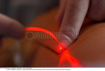 Vascular laser