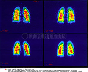 Lung scintigraphy