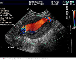 Aneurysm of the abdominal aorta