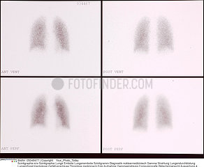 Lung scintigraphy