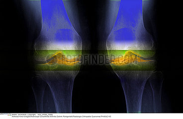 Arthrosis of the knee