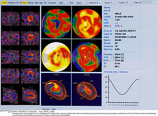 Heart scintigraphy
