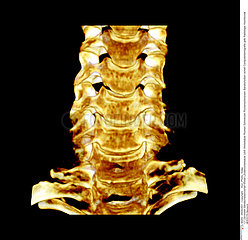 Cervical backbone