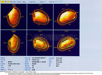Heart scintigraphy