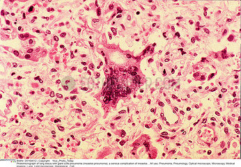 Giant cells pneumonia