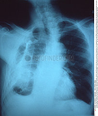 Fibrothorax