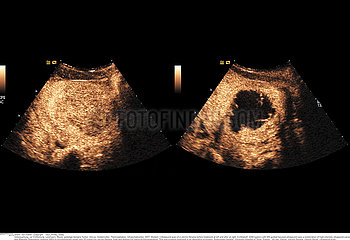 Focused ultrasound treatment of uterine leiomyoma