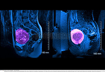 Focused ultrasound treatment of uterine leiomyoma