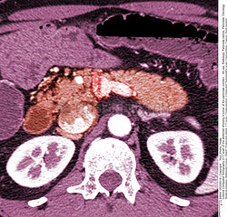 Pancreas tumor