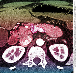 Pancreas tumor