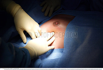 Breast cancer surgery