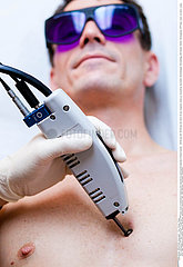 Dermatological laser