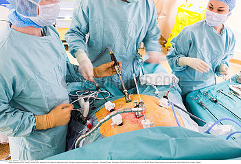 Reportage_165 Magenverkleinerung / Laparoscopic Sleeve Gastrectomy