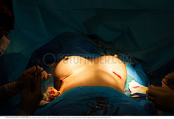 Reportage_217 PIP Brustimplantat ersetzen / Plastic surgery