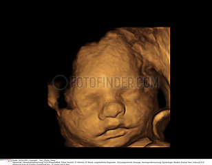Foetus