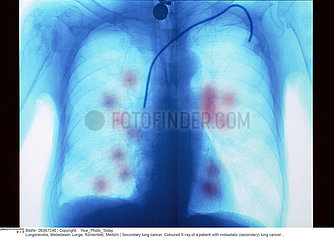 Secondary lung cancer