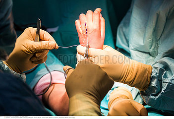 Hand surgery