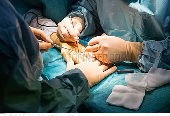 Hand surgery
