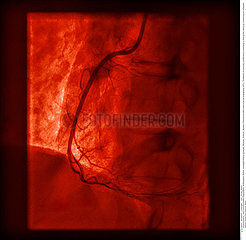 Transluminal angioplasty